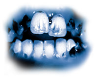 המרכיבים הרעילים במט' גורמים לריקבון שיניים חמור שידוע בכינוי 